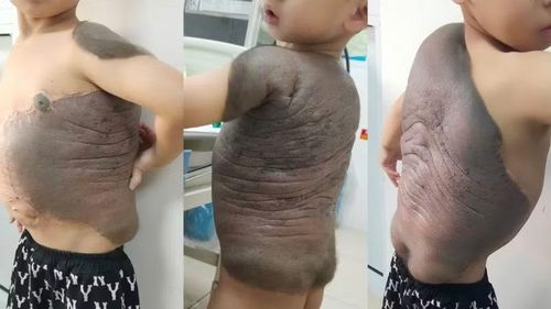 Hình ảnh khối u khổng lồ của bệnh nhi.