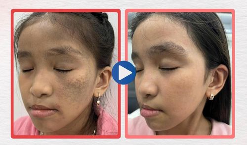 Sau 13 buổi kiên trì, Hương Trà đã được xóa sạch vết bớt Ota xanh xám lan rộng nửa khuôn mặt, kéo dài từ đỉnh đầu xuống trán và má.