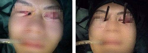 Bệnh nhân bị đũa cắm sâu vào hốc mắt (ảnh trái) và sau khi được lấy ra