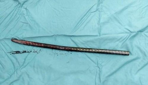 Cây xà beng được lấy ra từ người bệnh nhân