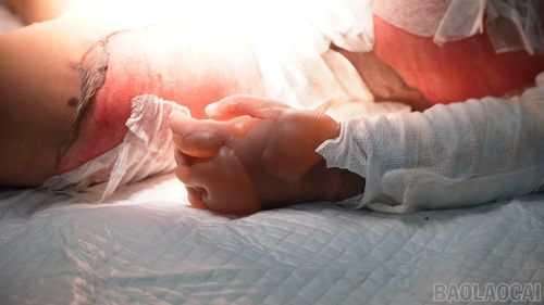 Bệnh nhi bị bỏng độ II, III, tổn thương gần 45% diện tích cơ thể tại vùng mặt, bụng, lưng, tay và chân.