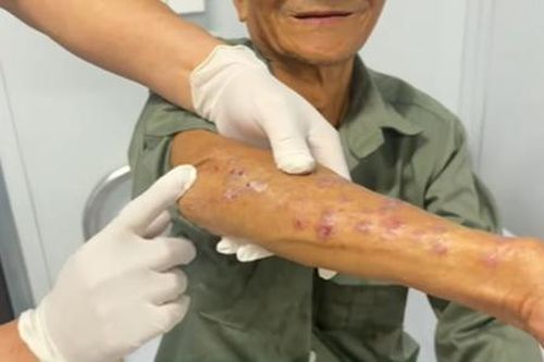 Trước đó, người bệnh xuất hiện nhiều u cục bội nhiễm trên da. Ảnh: BVCC.