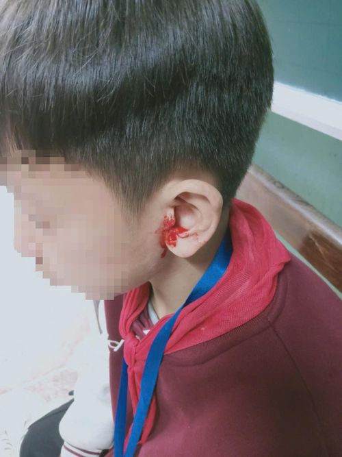 Hình ảnh em T. bị chảy máu vùng tai được bà Ngô Xuân Thúy - nhân viên y tế Trường PTDT nội trú Yên Thế -chụp lại