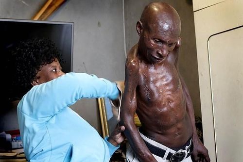 Người đàn ông mắc bệnh "người hóa đá". Ảnh: ANA Pics.