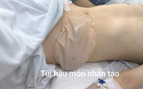  Bệnh nhân phải làm hậu môn nhân tạo tạm thời. 