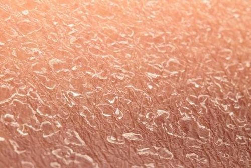 Không ít trẻ vảy cá bẩm sinh bị phát hiện muộn do gia đình nghĩ chỉ là khô da. Ảnh: BVCC.