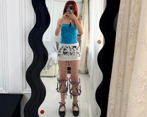 Áp lực ngoại hình và tiêu chuẩn chiều cao đang tạo điều kiện cho các đường dây phẫu thuật kéo dài chân trái phép phát triển. Ảnh minh họa: Rednote.