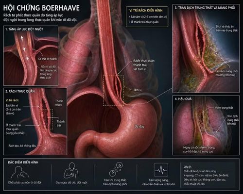 Biểu hiện của hội chứng Boerhaave - Ảnh BVCC