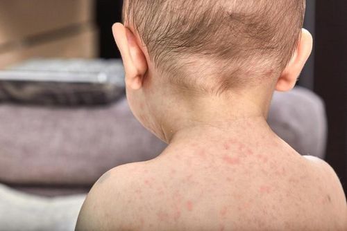Theo CDC Mỹ, có tới 93% số ca mắc sởi trong năm nay chưa tiêm vaccine hoặc không rõ tình trạng tiêm chủng, trong đó hơn một nửa số ca là trẻ em và thanh thiếu niên từ 5 đến 19 tuổi. Ảnh: Aleksandr Pykhteev/ iStock