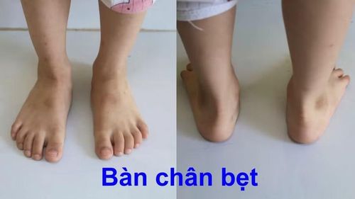 Bác sĩ thăm khám, đánh giá tình trạng bàn chân bẹt ở trẻ em. Ảnh: Bệnh viện 1A
