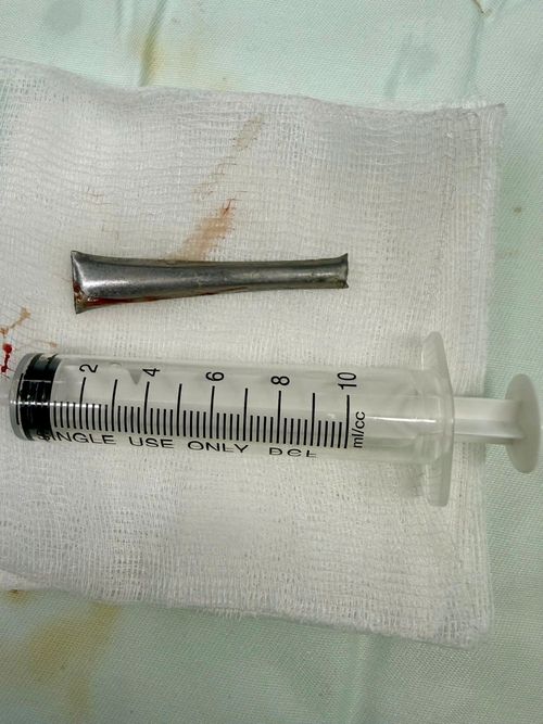 Chiếc cán thìa được đưa ra khỏi cơ thể người đàn ông sau hơn 1 tháng "ẩn náu"