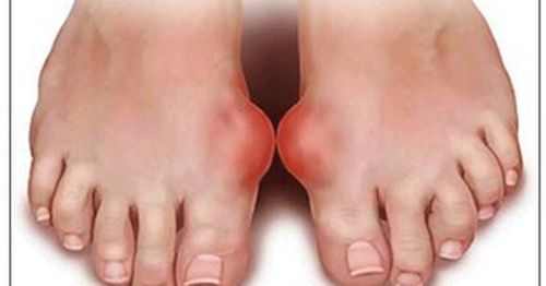 Người bệnh mắc gout mạn tính nhiều năm với nhiều hạt tophi lớn.