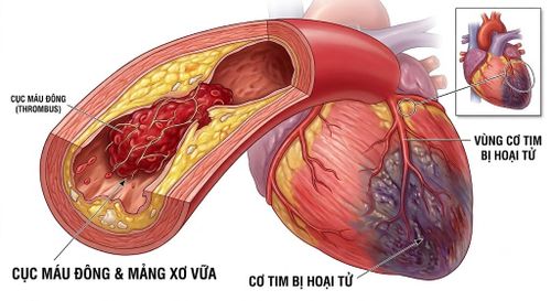 Bụi mịn và các chất ô nhiễm có thể thúc đẩy quá trình viêm, làm mất ổn định các mảng xơ vữa trong động mạch vành.