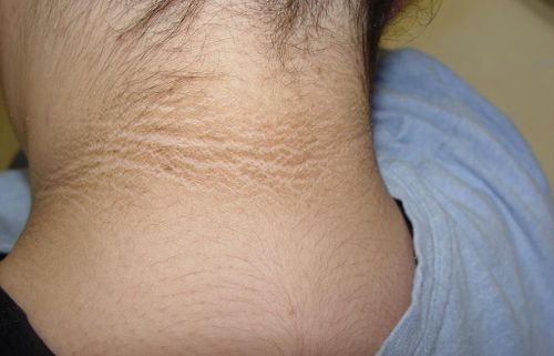  Vùng da sẫm màu sờ vào có cảm giác mịn như nhung thường là dấu hiệu điển hình của kháng insulin. Ảnh: Shutterstock. 