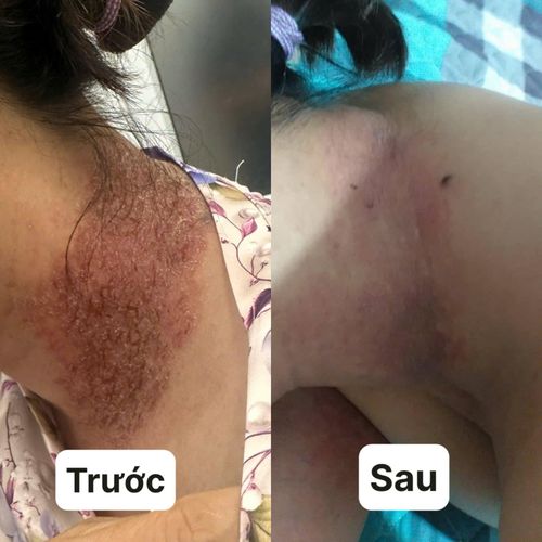 Bệnh Hailey-Hailey là bệnh da liễu di truyền hiếm gặp, chỉ xảy ra ở khoảng 1/50.000 người. Ảnh: BVCC