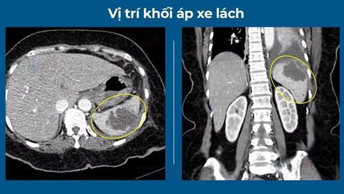 Vị trí khối áp xe lách.