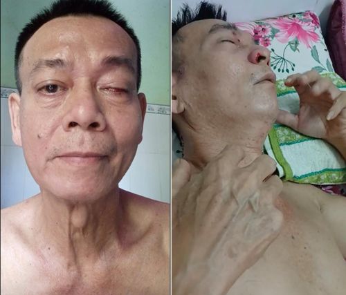 Bệnh tật khiến anh Dũng mất thị lực một mắt, liệt một bên mặt... Ảnh: NVCC