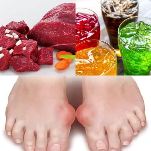 Người bệnh gout cần hạn chế phủ tạng động vật, nước dùng hầm xương đậm đặc, thịt đỏ ăn quá nhiều, các loại hải sản giàu purin, bia rượu và đồ uống có nhiều đường fructose. Ảnh M.H