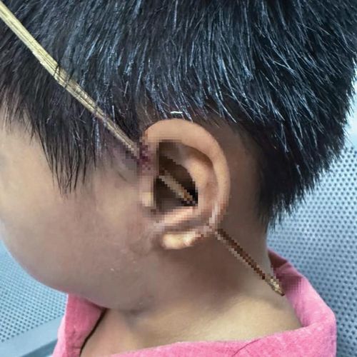 Que tre đâm xuyên vành tai bé trai. Ảnh: BVCC.
