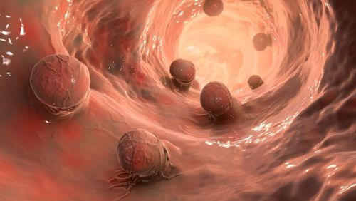 Phần lớn ung thư đại trực tràng phát triển từ các polyp tuyến trong niêm mạc đại tràng. Ảnh: Shutterstock.