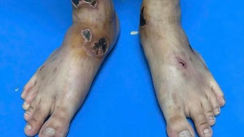 Hình ảnh tổn thương của bệnh nhân sau 2 tuần điều trị.