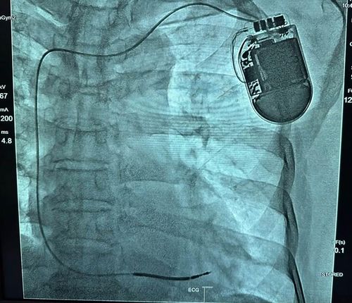 Bệnh nhân được cấy máy phá rung tự động - Ảnh BVCC