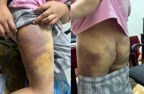Một số dấu vết thương trên cơ thể cháu gái P.G.K.L.