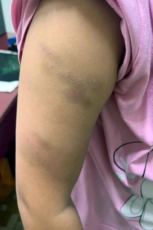 Các thương tích còn trên tay cô bé 11 tuổi sau những trận đòn của người tình của mẹ