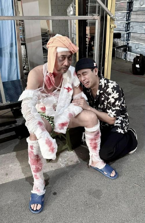 NSƯT Hồ Phong băng bó đầy người để phục vụ cho cảnh quay Lão Công bị bỏng nặng sau vụ nổ xe. 