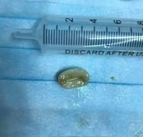 Hạt lạc được lấy ra từ phổi bệnh nhân - Ảnh BVCC