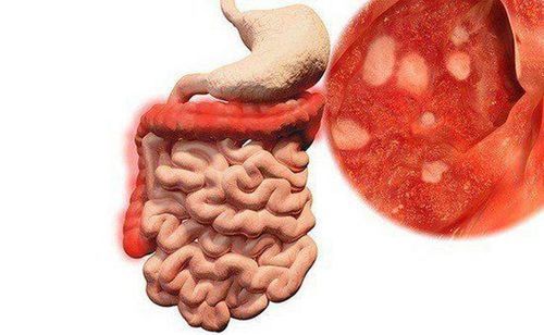 Viêm ruột là tình trạng viêm mạn tính xảy ra ở đường tiêu hóa. Ảnh AI