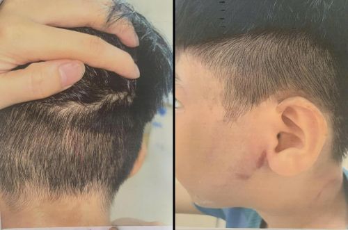 Cháu B. được xác định có nhiều vết bầm tím trên cơ thể sau khi bị đánh. Ảnh: GĐCC