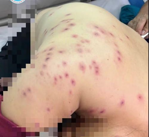 Người bệnh bị hàng trăm mũi ong đốt - Ảnh BVCC