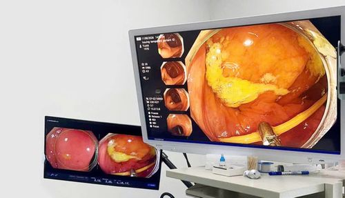 Các bác sĩ nội soi gắp cây tăm tre từ ổ bụng bệnh nhân.