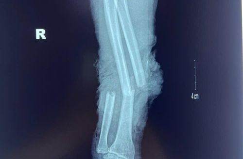Phim chụp cánh tay bị gãy xương của bệnh nhân