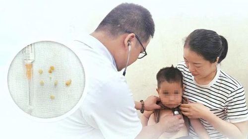 Cứu sống bé trai 2 tuổi nguy kịch do hóc hạt lạc, dị vật bít kín cả hai bên phế quản. Ảnh: BVCC.