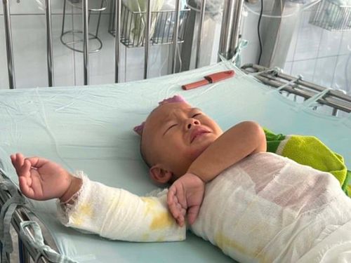 Những cơn đau do tổn thương bỏng khiến Nhân quấy khóc suốt ngày đêm