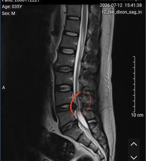 Hình ảnh thoát vị đĩa đệm L4-L5, chèn ép rễ thần kinh L5 cả hai bên trên phim chụp MRI - Ảnh BVCC