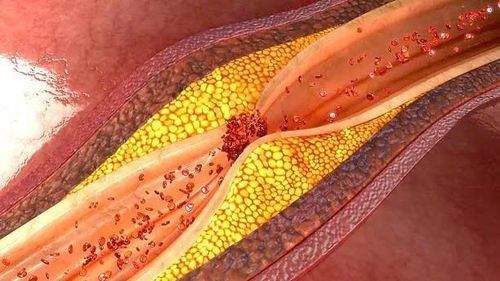 Mảng xơ vữa bị nứt, vỡ có thể kích hoạt hình thành cục máu đông, gây tắc nghẽn mạch và dẫn đến nhồi máu cơ tim hoặc đột quỵ. Ảnh: Unsplash.