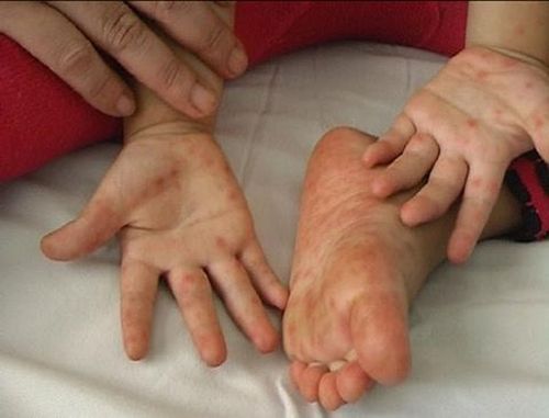 Trẻ mắc bệnh TCM cần được theo dõi sức khỏe thường xuyên và vệ sinh cơ thể. Ảnh: NGUYỄN MINH 