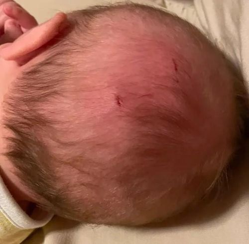 Có thể thấy rõ vết cắn trên đầu Josephine. Ảnh: SWNS