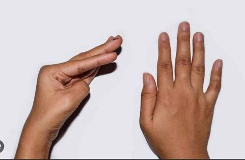 Người bị hạ canxi có thể tê hoặc châm chích đầu ngón tay, đầu ngón chân. Ảnh BV