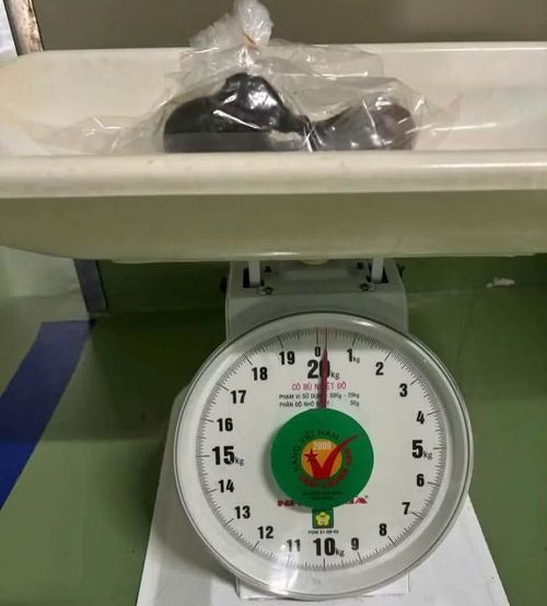 Khối tóc được lấy ra trong đường tiêu hóa của bệnh nhi.