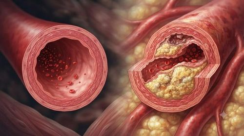 LDL-C có thể đi vào và lưu giữ trong thành động mạch, khởi đầu quá trình hình thành mảng xơ vữa, từ đó làm tăng nguy cơ nhồi máu cơ tim, đột quỵ thiếu máu não và bệnh động mạch ngoại biên.