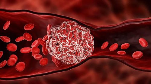 Trong mô hình mạch máu sử dụng thuốc tiêu sợi huyết tPA, cục máu đông được phân giải trong khoảng 40 phút khi robot hoạt động, so với trung bình khoảng 70 phút khi không sử dụng thiết bị. Ảnh: The Economic Times.