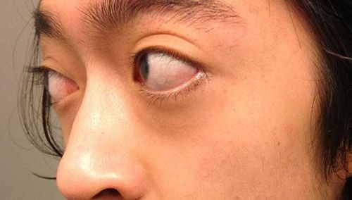 Lồi mắt trong bệnh Basedow là hậu quả của quá trình viêm tự miễn. Ảnh ST