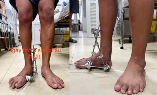 Bàn chân của bệnh nhân đã tiếp xúc với mặt đất sau 21 năm từ lúc sinh ra. (Ảnh: Bệnh viện cung cấp).