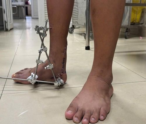 Hình ảnh bàn chân chàng trai trước và sau phẫu thuật. Ảnh: BSCC.