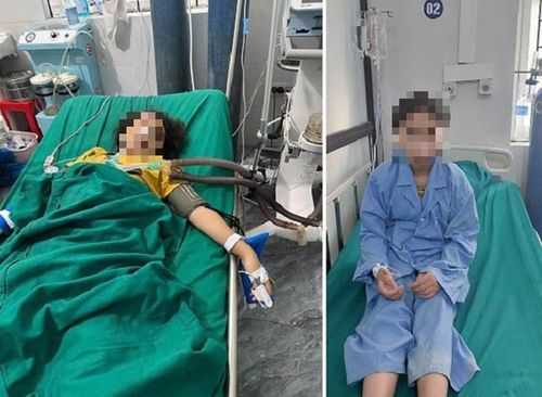 Hình ảnh bệnh nhi 12 tuổi được cấp cứu và theo dõi điều trị tại bệnh viện. Ảnh: BVCC.