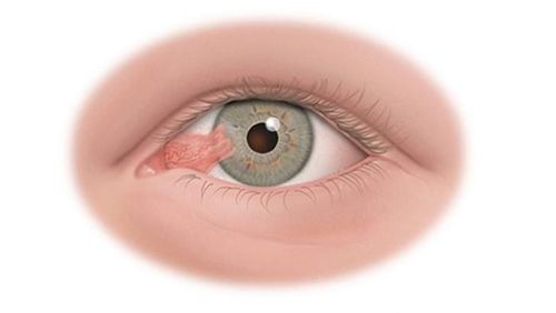 Nếu không được phát hiện và điều trị kịp thời, tổn thương giác mạc có nguy cơ nhiễm trùng, loét rách giác mạc. Ảnh AI